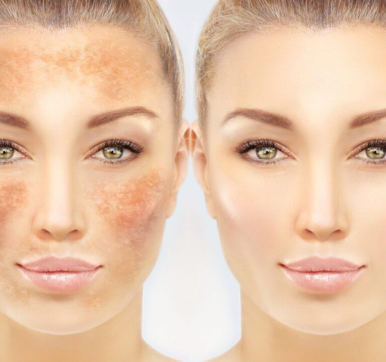 Myths and Facts about Hyperpigmentation Treatment