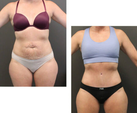 tummy tuck near me NYC